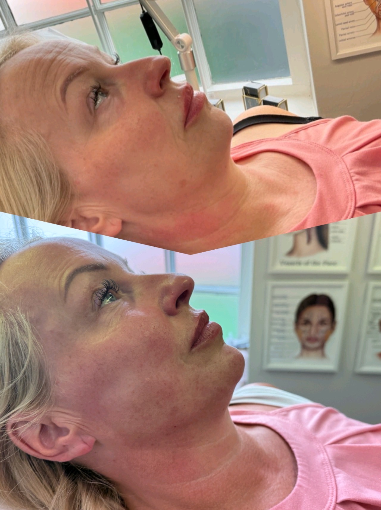 Ziba Aesthetics Clinic St Ives Before And After Glow