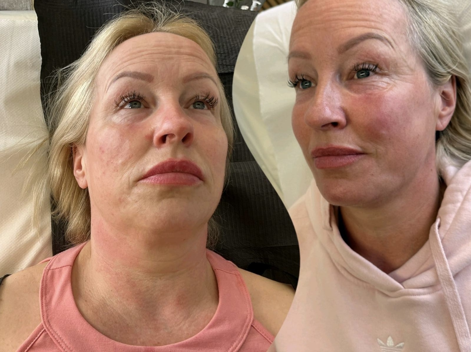 Ziba Aesthetics Clinic St Ives Before And After Glow