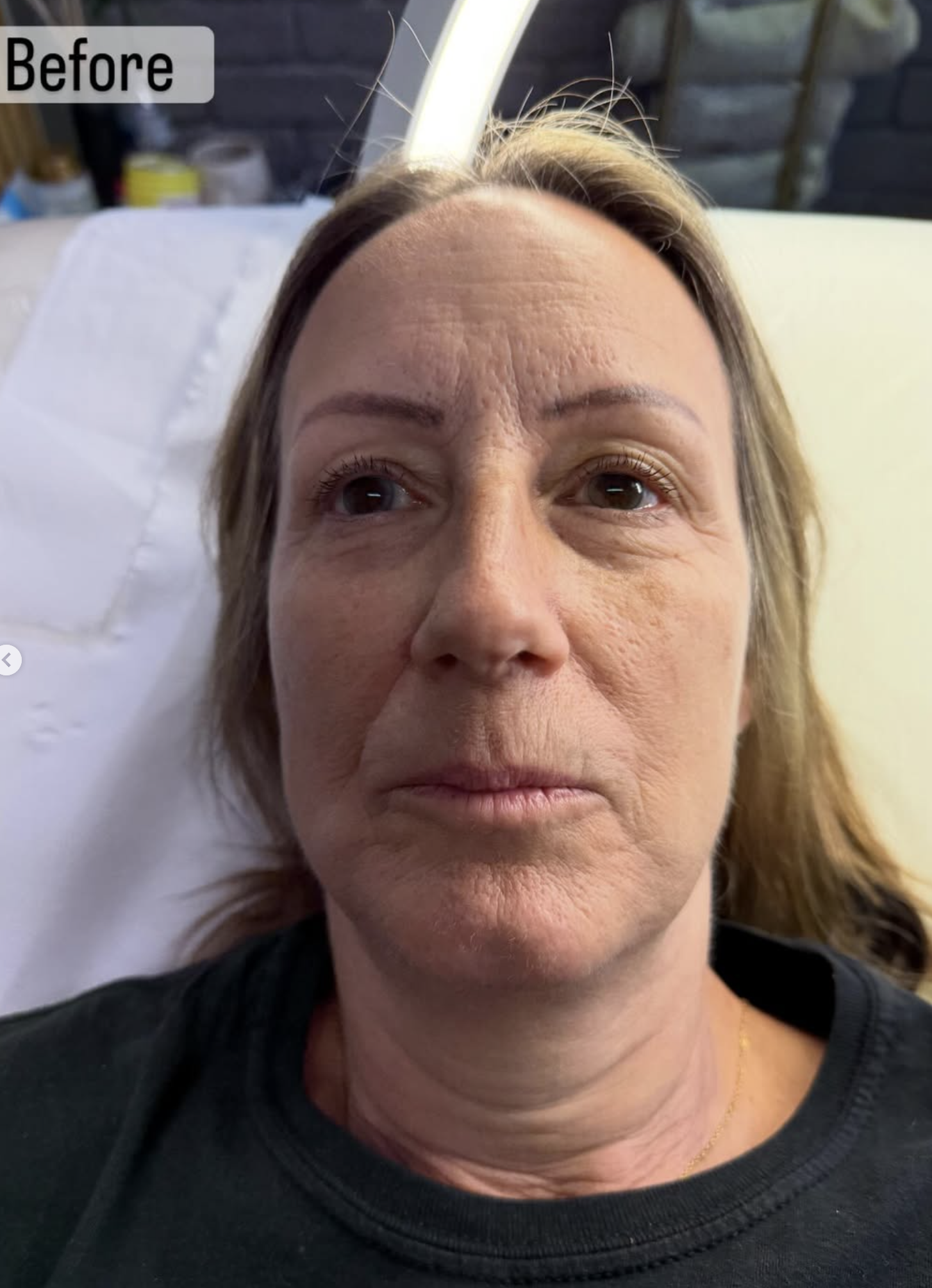 Ziba Aesthetics St Ives Clinic | Before