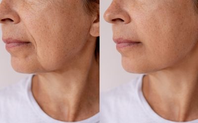 Wondering If Jawline Fillers Are Right for You? Cambridge’s Best Kept Secret Revealed!